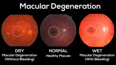 Macular Degeneration | Endo Eye Doctor in Honolulu | Optometrist in ...