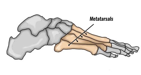 Metatarsal Stress Fracture - Symptoms, Causes and Treatment