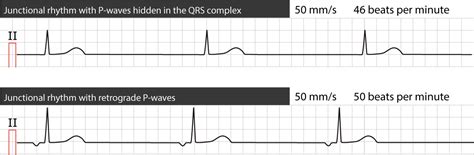 Junctional rhythm (escape rhythm) and junctional tachycardia – ECG learning