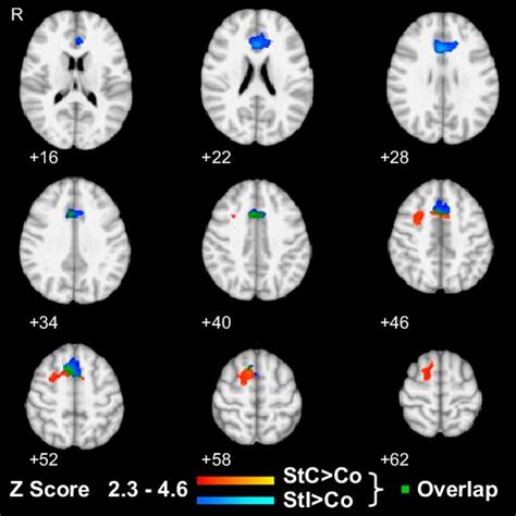 Frontal activation during response inhibition. Rendered images show ...