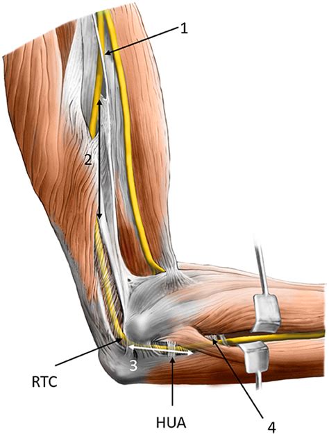 Frontiers | Ulnar Neuropathy at the Elbow: From Ultrasound Scanning to ...