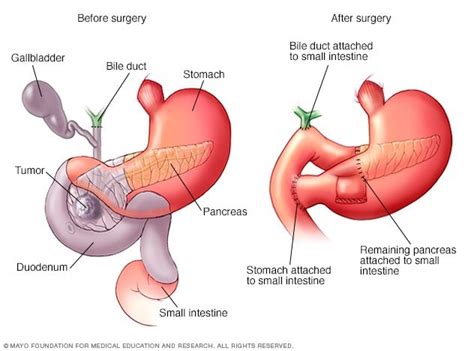 Surgery for Pancreatic Cancer (Overview) - THE OLIVE LABORATORY