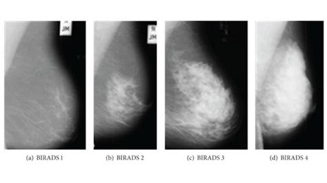 Mammogram Images Normal Abnormal And Breast Cancer