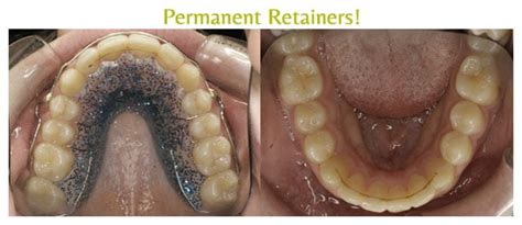 Permanent Retainer Libertyville IL Arpino Orthodontics Lake Bluff