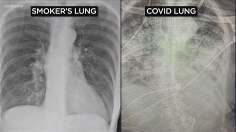 Unhealthy Healthy Lungs Xray - bmp-park