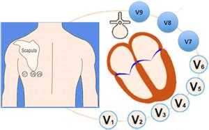 Posterior Leads ECG - ALiEM