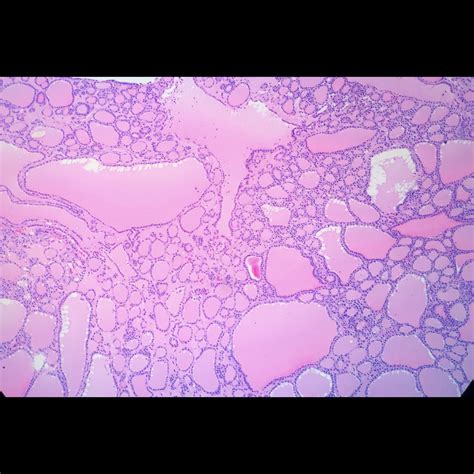 Multinodular Goiter Histology