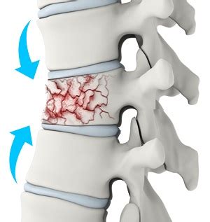 Spinal Compression Fractures Oklahoma City, OK | Minimally Invasive ...