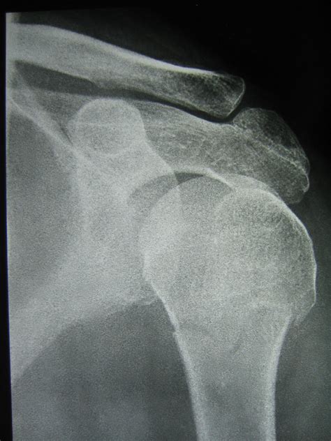 Xray.Shoulder.Fracture (image)