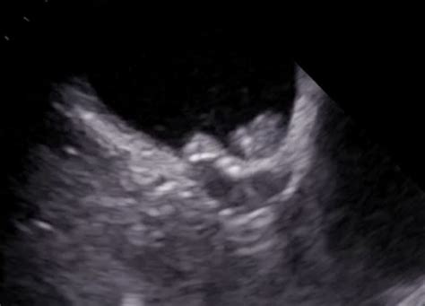 Percutaneous left atrial appendage occlusion discrepancy between ...