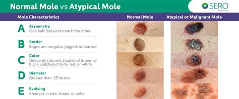 Cancerous Moles Vs Normal Moles