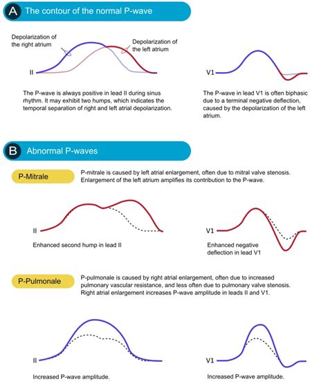 ECG interpretation: Characteristics of the normal ECG (P-wave, QRS ...