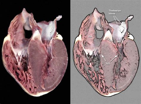 Hypertrophic cardiomyopathy — Medlibes: Online Medical Library