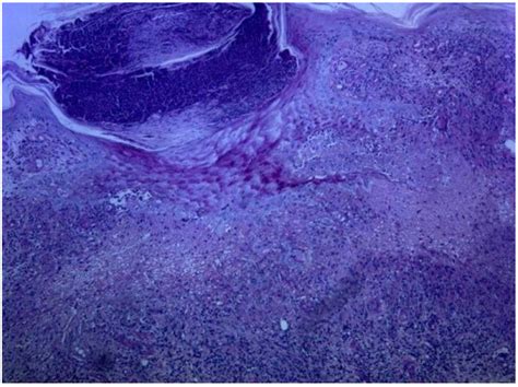 Granuloma Annulare Histopathology