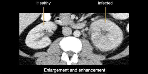 Abdominal CT: renal infections • LITFL • Radiology Library