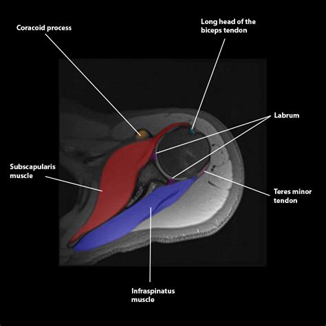 CaseStacks.com - Shoulder MRI Anatomy