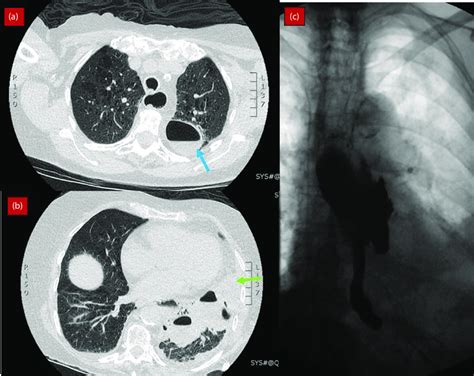 6 (a and b): CT scan of chest (axial views) demonstrating gas filled ...