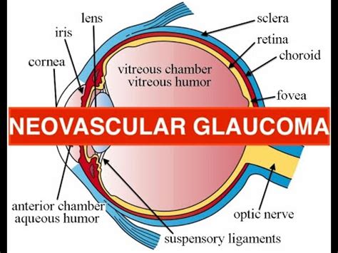 neovascular glaucoma - etiology, causes, course, treatment - YouTube