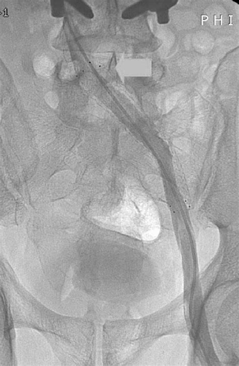 Stent is inserted to the compressed site of left common iliac vein ...