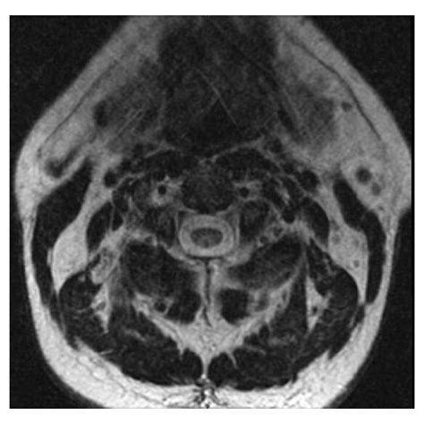 MRI of the cervical spine showing abnormal signal in the posterior ...