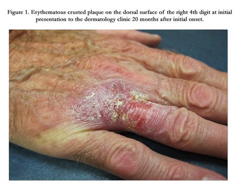 Chronic Cutaneous Blastomycosis