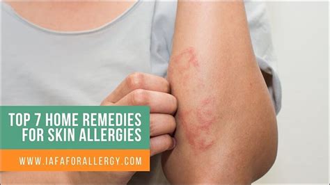 Top 7 Home Remedies for Skin Allergies - Ayurvedic Treatment