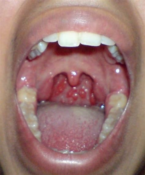 Persistent Sore Throat - Chronic Pharyngitis- Laser Treatment - Dr Paulose