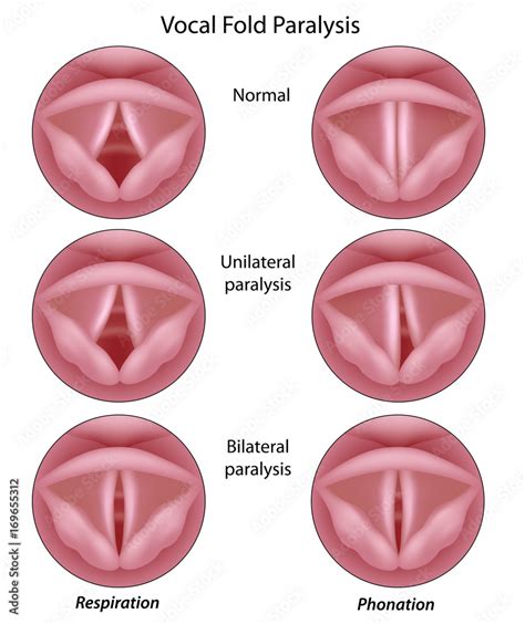 Vocal cord paralysis Stock Illustration | Adobe Stock