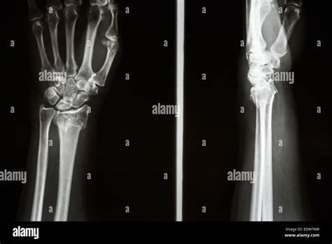 Colles fracture osteoporosis - bmlery