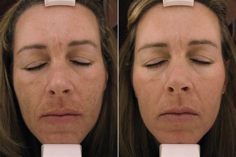 Melanage – The Secret of Melasma Treatment | Lower Gwynedd, PA Patch