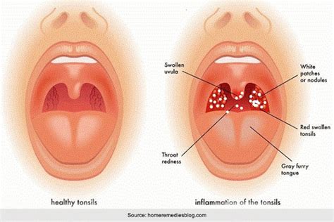 Mononucleosis Throat : Mono Symptoms Warning Signs Of Mononucleosis ...