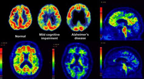 Amyloid PET imaging improve diagnosis and Alzheimer's treatment - https ...