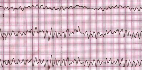 Ventricular fibrillation – ECG – All About Cardiovascular System and ...