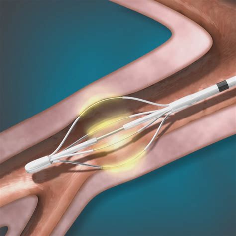 The Alair Bronchial Thermoplasty System - Boston Scientific