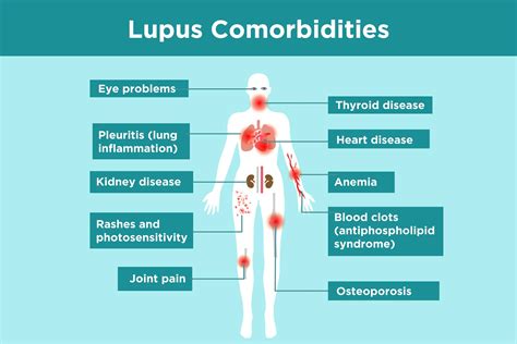 Lupus Complications: What Lupus Patients Need to Know