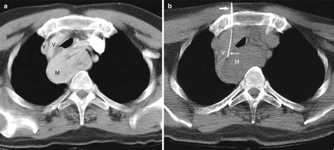 Biopsy of Mediastinal Lesions | Radiology Key