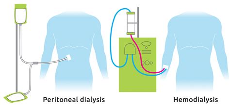 2 types dialysis-sidebyside - Transplant Living