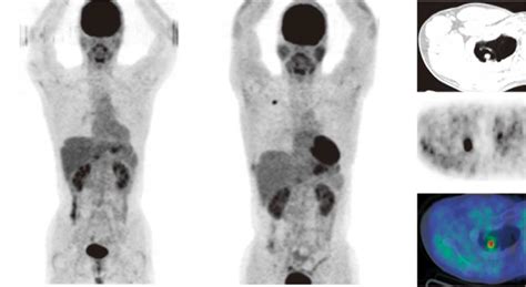 A case of primary lung cancer lesion demonstrated by F-18 FDG positron ...