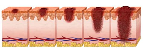 What Each Melanoma Stage Means