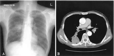 Figure 1 from Mycobacterium Kansasii Disease Presenting As a Lung Mass ...