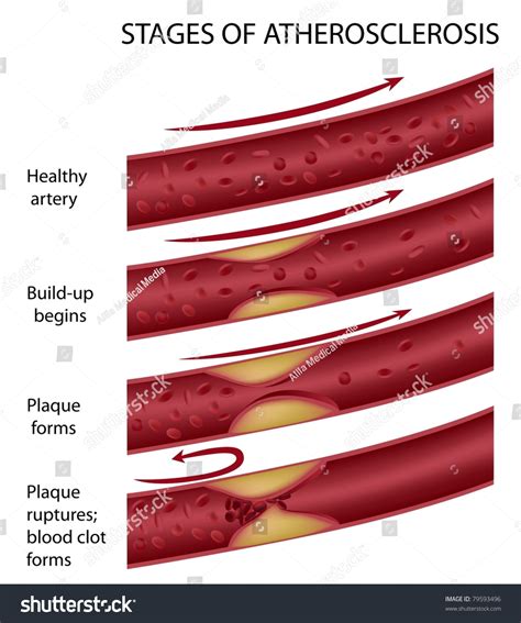 Stages Of Atherosclerosis Stock Photo 79593496 : Shutterstock