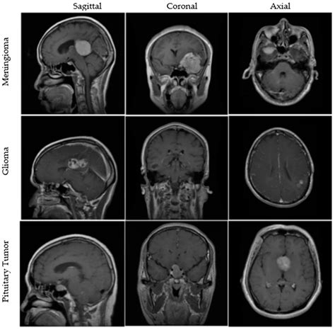 Mri Brain Tumor Pituitary