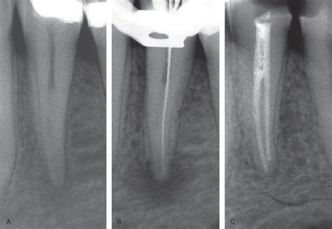 Apical Periodontitis Radiograph