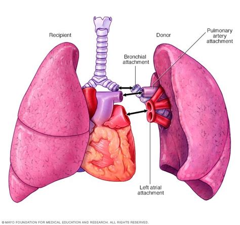 Lung transplant - Drugs.com