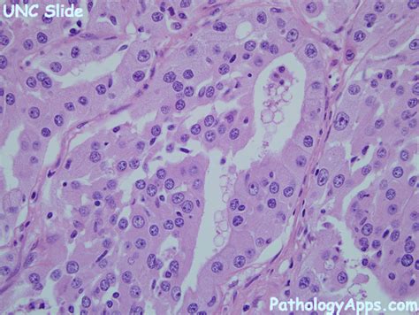 cholangiocarcinoma pathology