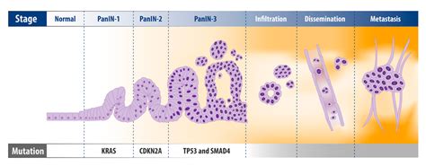 Challenges and Opportunities in Pancreatic Cancer Research