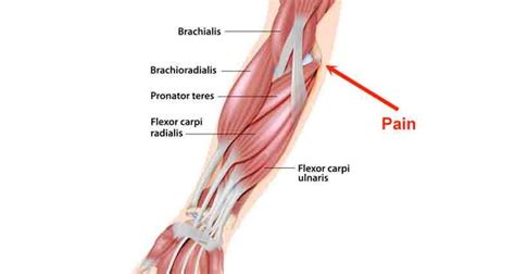 Golfer's Elbow - Symptoms, Causes, Treatment & Rehabilitation