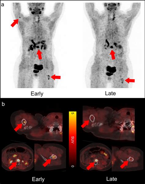 A 49-year-old woman with multiple bone metastasis of differentiated ...