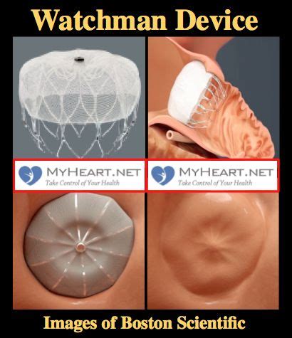 What is the Watchman Device (Also known as Watchman Procedure, Watchman ...