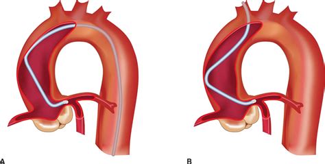 Tips and Tricks for Diagnostic Angiography and Intervention | Thoracic Key